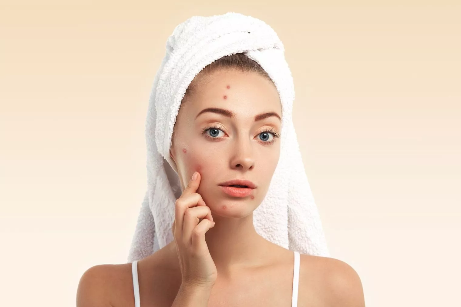 Benarkah Acne Patch Efektif dalam Mengatasi Jerawat?