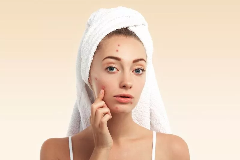 Benarkah Acne Patch Efektif dalam Mengatasi Jerawat?