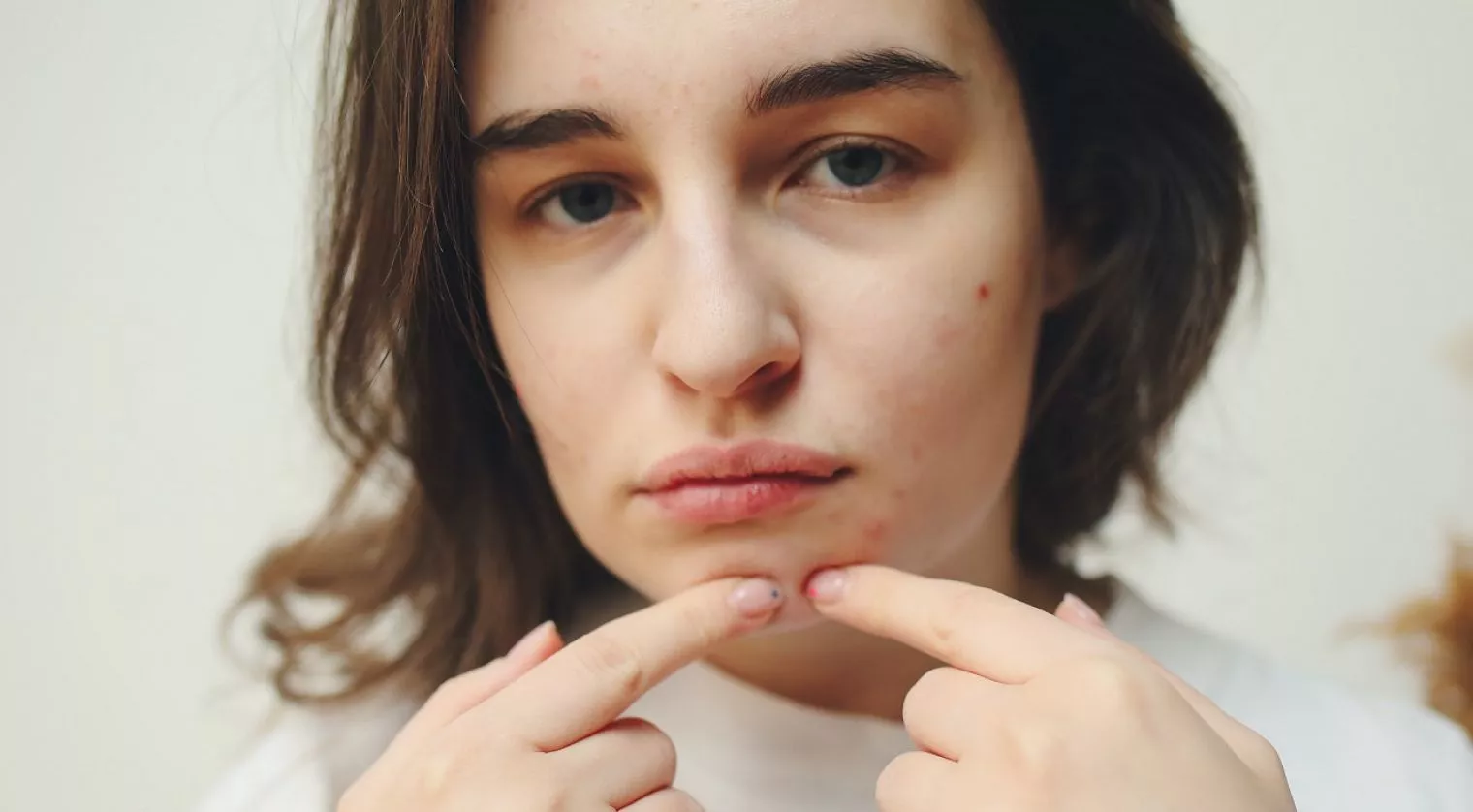 Jerawat di Vagina, Belum Tentu Berbahaya!