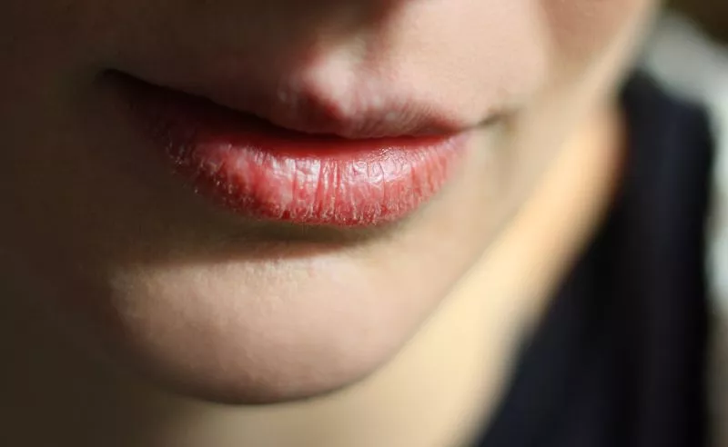 Mengatasi Bibir Kering dan Mengelupas