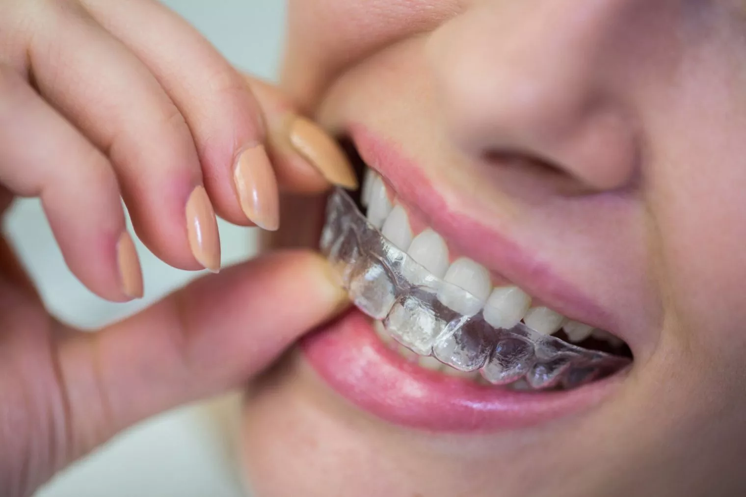 Invisalign; Solusi Tepat Pengganti Kawat Gigi Biasa