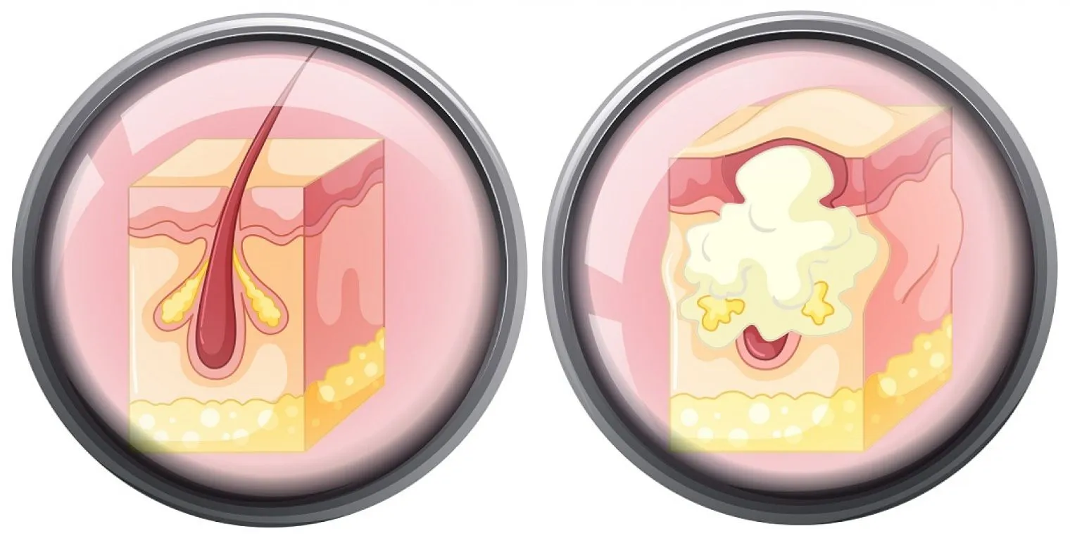 Bisul Bukan Terjadi Karena Konsumsi Telur