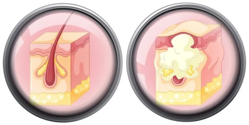 Bisul Bukan Terjadi Karena Konsumsi Telur