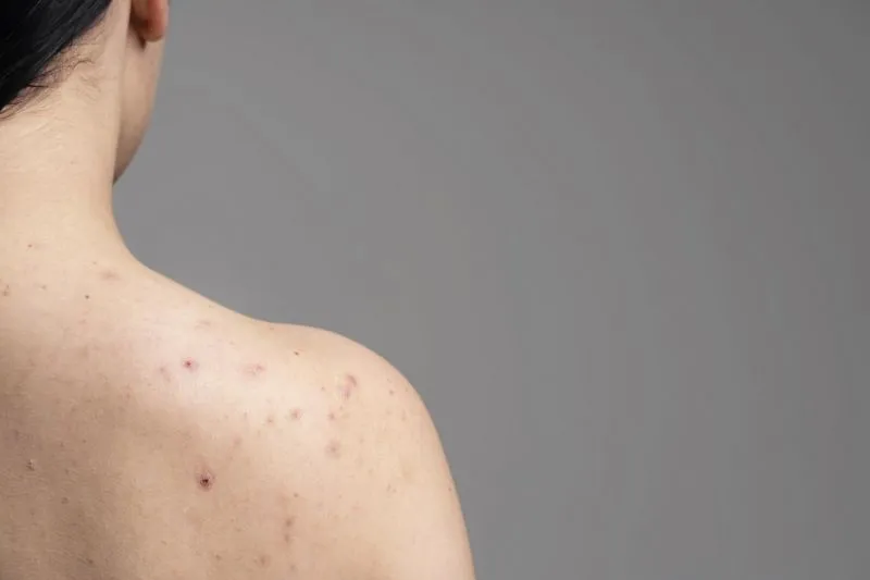 Fungal Acne Tidak Sama dengan Jerawat Biasa