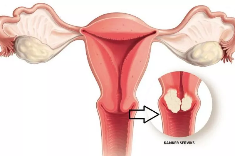 Kenali Kanker Serviks: Penyebab, Gejala, dan Pengobatan