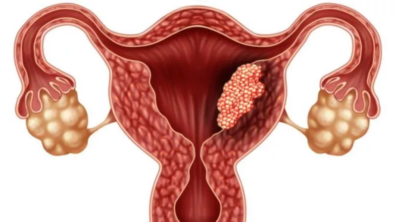 Apa yang Terjadi jika Kanker Serviks Tidak Ditangani?