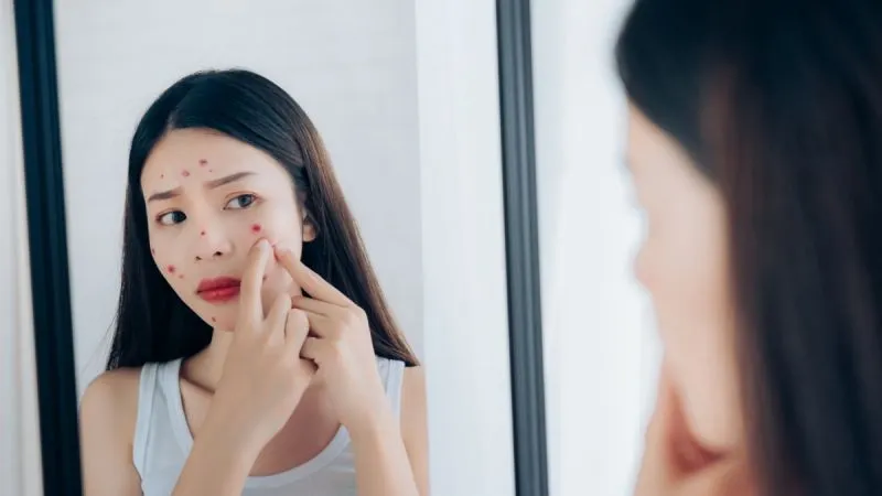 Batasi Makanan Ini Saat Berjerawat!