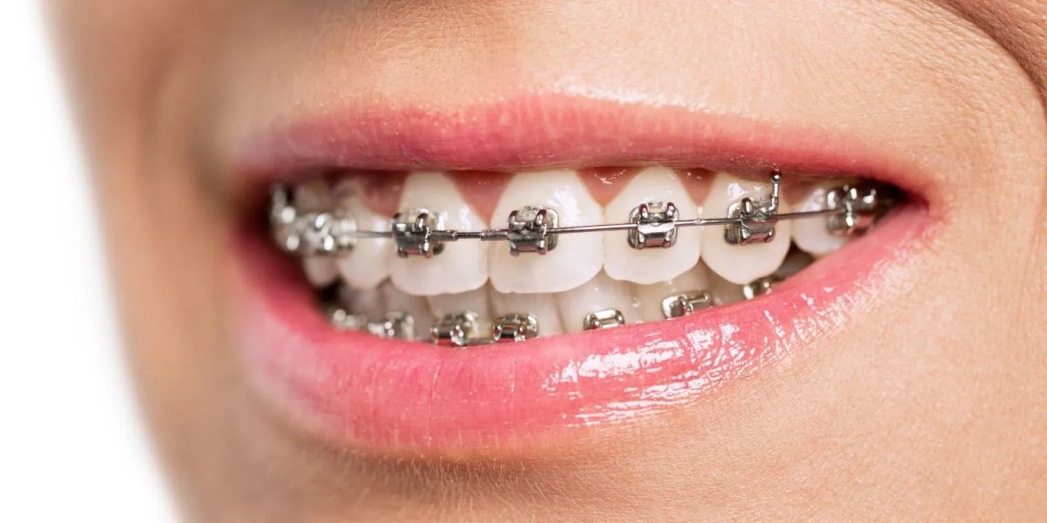 Behel Gigi: Manfaat, Proses Pemasangan, dan Perawatan