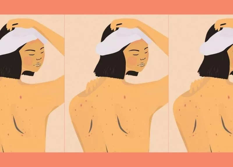 Tips Mengatasi Jerawat di Punggung